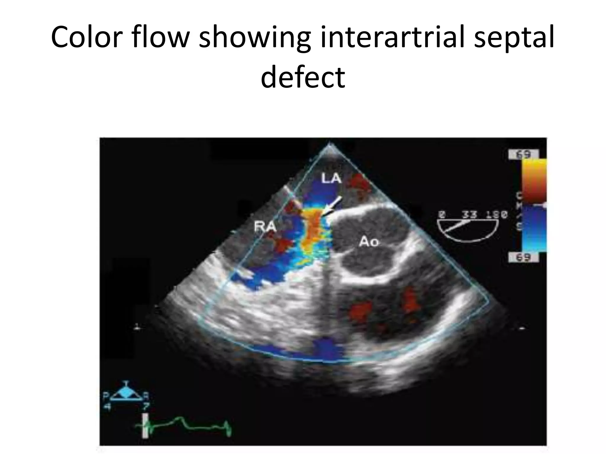 Color flow showing interartrial septal
defect
 
