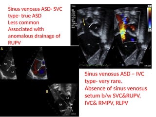 Atrial Septal Defect_Naznin_madam_all_pptx | PPTX