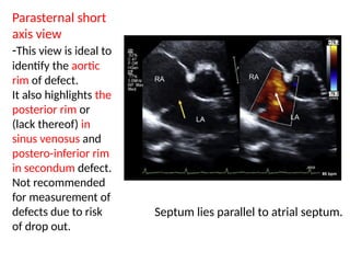 Partial Peripheral Rim Defect Atrial Septal Defect_Naznin_madam_all_pptx | PPTX