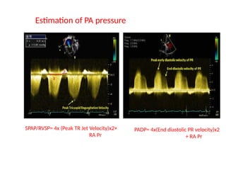 Tr Jet Rvsp Atrial Septal Defect_Naznin_madam_all_pptx | PPTX