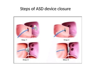 Atrial Septal Defect_Naznin_madam_all_pptx | PPTX
