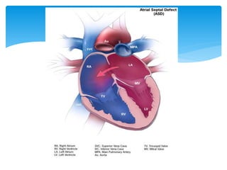 Comprehensive Overview of Atrial Septal Defect (ASD): Causes, Symptoms ...