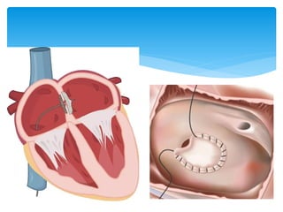 Comprehensive Overview of Atrial Septal Defect (ASD): Causes, Symptoms ...