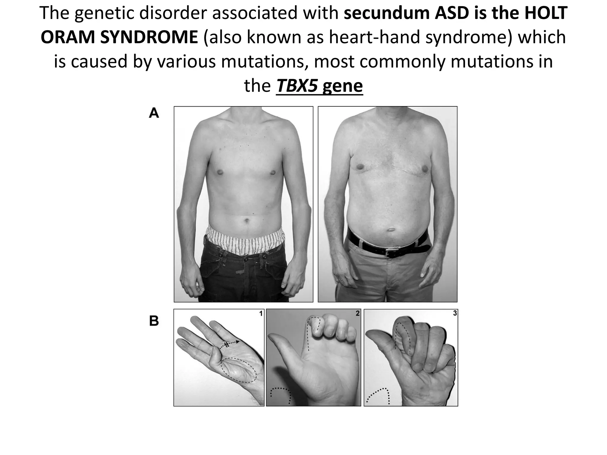 Atrial septal defect | PPT | Free Download