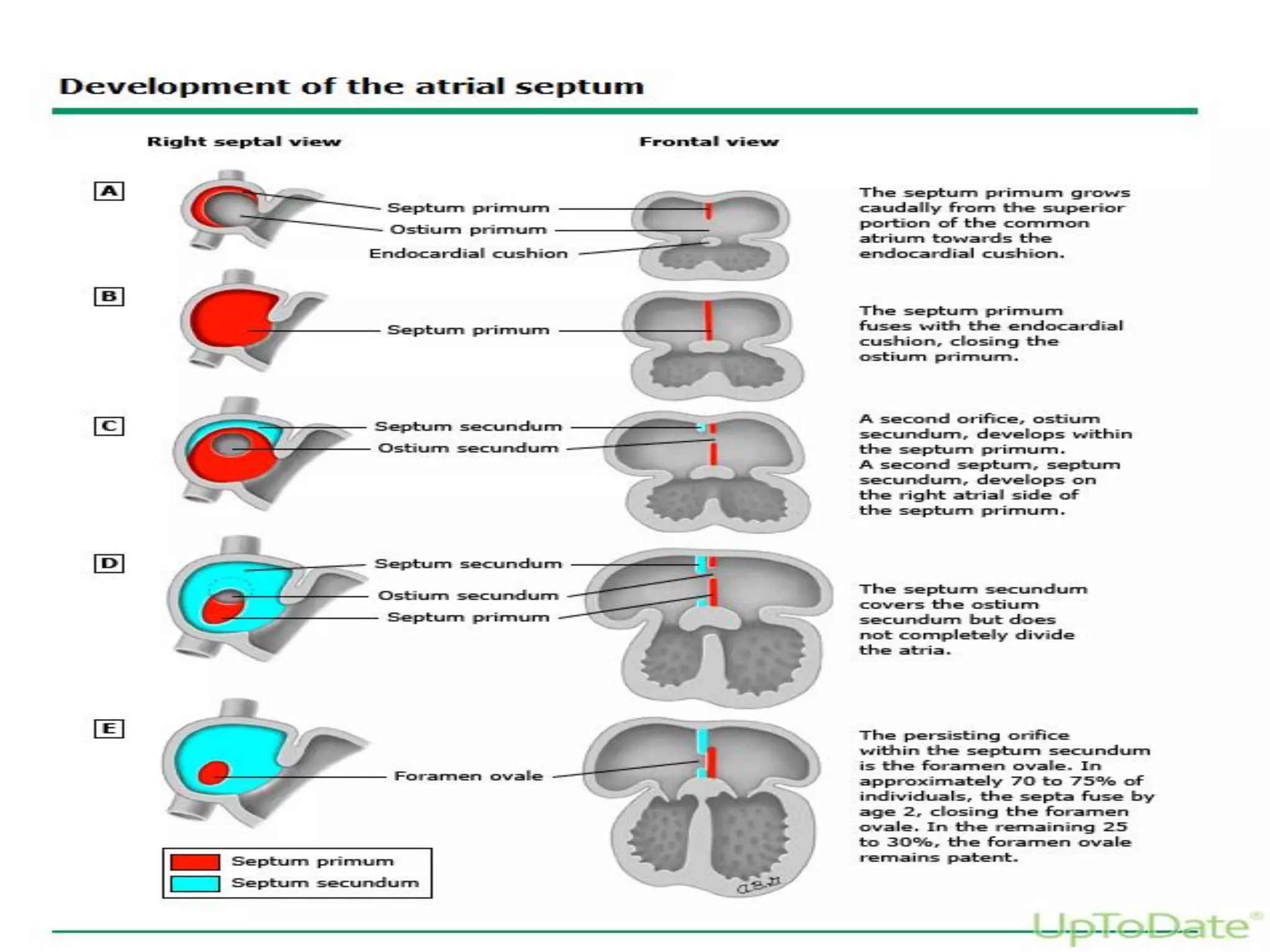 Atrial septal defect | PDF