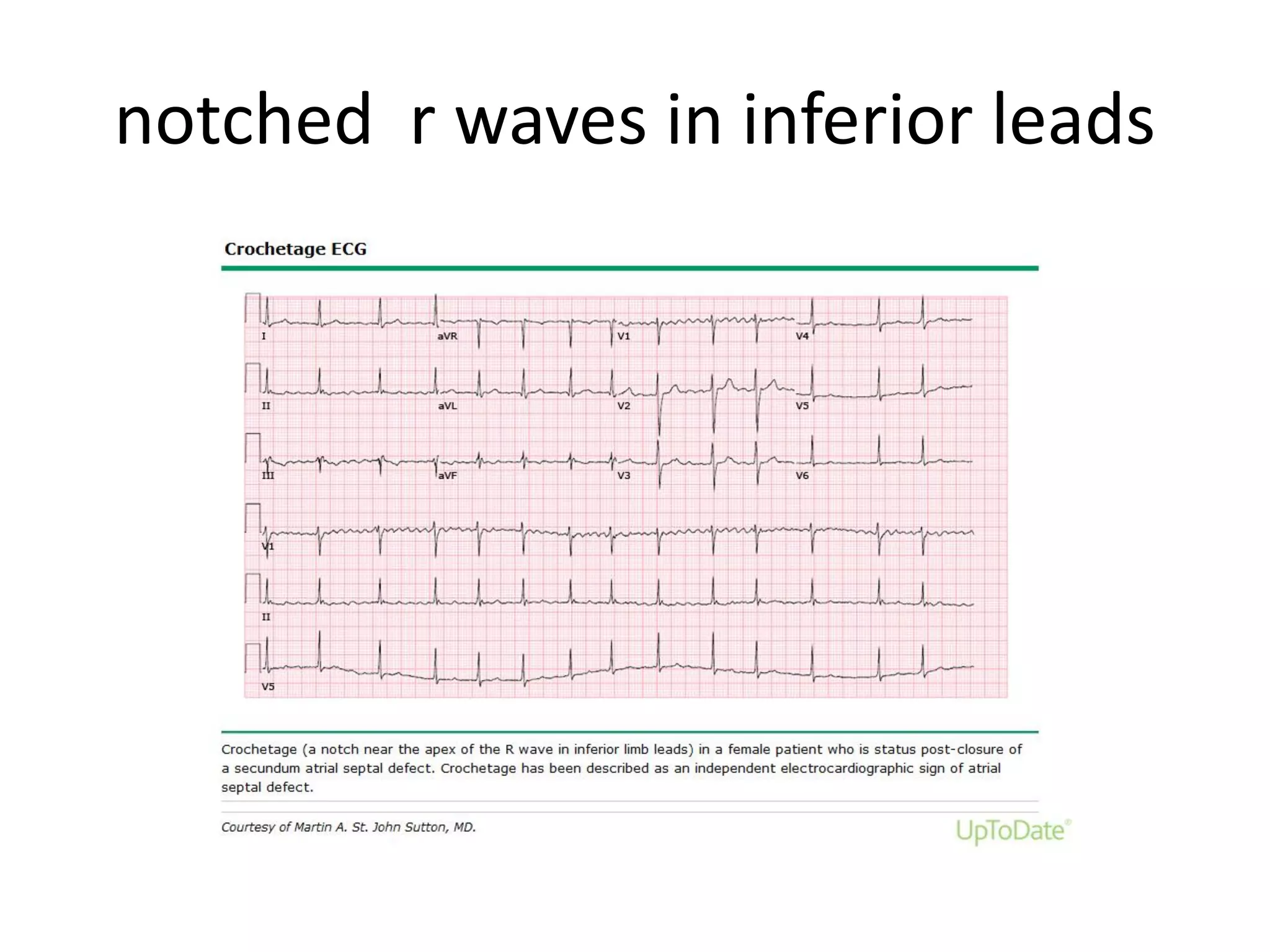 Atrial septal defect | PDF