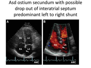Asd ostium secundum with possible
drop out of interatrial septum
predominant left to right shunt
 