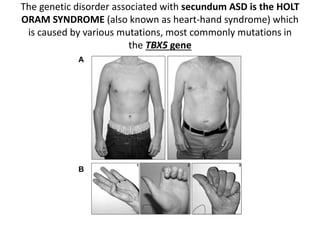 The genetic disorder associated with secundum ASD is the HOLT
ORAM SYNDROME (also known as heart-hand syndrome) which
is caused by various mutations, most commonly mutations in
the TBX5 gene
 
