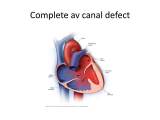 Complete av canal defect
 