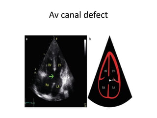 Av canal defect
 
