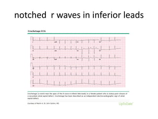 notched r waves in inferior leads
 