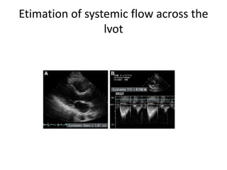 Etimation of systemic flow across the
lvot
 