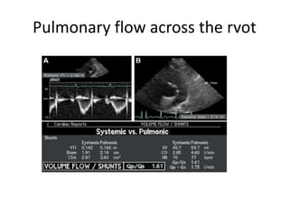 Pulmonary flow across the rvot
 