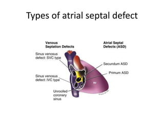 Types of atrial septal defect
 