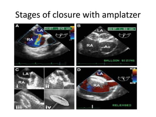 Stages of closure with amplatzer
 