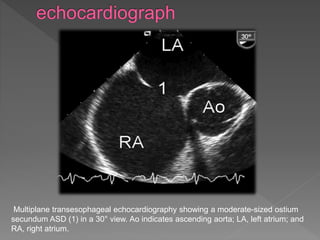 Multiplane transesophageal echocardiography showing a moderate-sized ostium
secundum ASD (1) in a 30° view. Ao indicates ascending aorta; LA, left atrium; and
RA, right atrium.
 