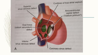 ATRIAL SEPTAL DEFECT Theory part for Pediatrics .pptx