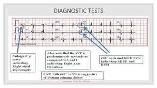 Atrial septal defect (ASD) | PPTX