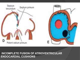 INCOMPLETE FUSION OF ATRIOVENTRICULAR
ENDOCARDIAL CUSHIONS
 