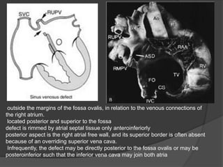outside the margins of the fossa ovalis, in relation to the venous connections of
the right atrium.
located posterior and superior to the fossa
defect is rimmed by atrial septal tissue only anteroinferiorly
posterior aspect is the right atrial free wall, and its superior border is often absent
because of an overriding superior vena cava.
Infrequently, the defect may be directly posterior to the fossa ovalis or may be
posteroinferior such that the inferior vena cava may join both atria
 