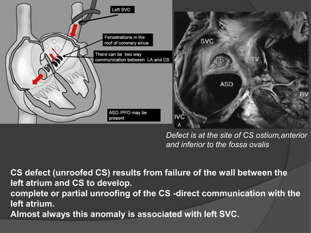 Atrial septal defects | PPTX