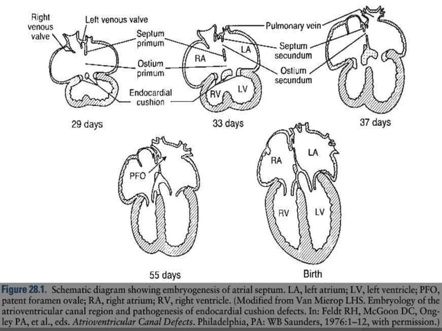 Atrial septal defects | PPTX