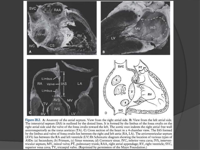 Atrial septal defects | PPTX