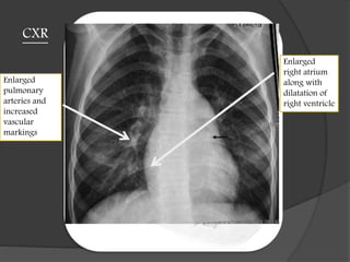 CXR
Enlarged
pulmonary
arteries and
increased
vascular
markings
Enlarged
right atrium
along with
dilatation of
right ventricle
 