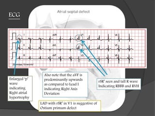 ECG
Enlarged ‘p’
wave
indicating
Right atrial
hypertrophy
rSR’ seen and tall R wave
Indicating RBBB and RVH
Also note that the aVF is
predominantly upwards
as compared to Lead I
indicating Right Axis
Deviation
LAD with rSR’ in V1 is suggestive of
Ostium primum defect
 