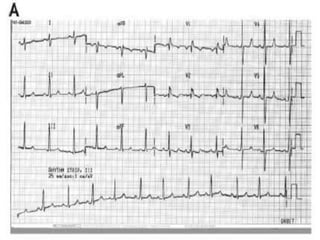 Atrial septal defects