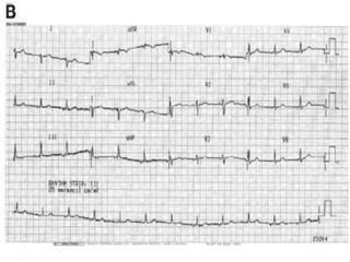 Atrial septal defects