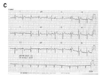 Atrial septal defects