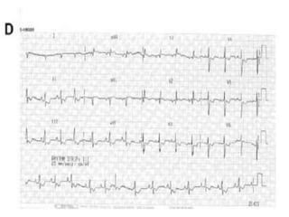 Atrial septal defects