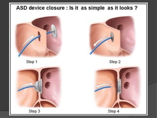 Atrial septal defects