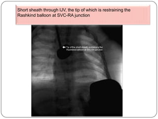 Atrial septostomy | PPTX