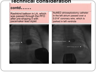 Atrial septostomy | PPTX