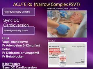 STABLE
HAEMODYNAMICALLY UNSTABLE
Hemodynamically Unstable
Sync DC
Cardioversion
Hemodynamically Stable
ECG
Vagal manoeuvre
IV Adenosine 6-12mg fast
bolus
IV Diltiazem or verapamil
IV Betablocker
If Ineffective
Sync DC Cardioversion
 