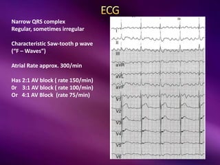 Narrow QRS complex
Regular, sometimes irregular
Characteristic Saw-tooth p wave
(“F – Waves”)
Atrial Rate approx. 300/min
Has 2:1 AV block ( rate 150/min)
0r 3:1 AV block ( rate 100/min)
Or 4:1 AV Block (rate 75/min)
 