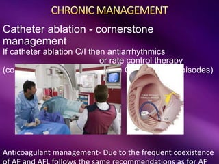 Catheter ablation - cornerstone
management
If catheter ablation C/I then antiarrhythmics
or rate control therapy
(considered after a first episode OR recurrent episodes)
Anticoagulant management- Due to the frequent coexistence
 