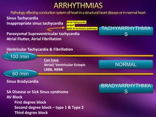 LEFT ATRIA
Sinus Tachycardia
Inappropriate sinus tachycardia
Paroxysmal Supraventricular tachycardia
Atrial Flutter, Atrial Fibrillation
Ventricular Tachycardia & Fibrillation
100 /min
60 /min
Sinus Bradycardia
SA Disease or Sick Sinus syndrome
AV Block
First degree block
Second degree block – type 1 & Type 2
Third degree block
Can have
Atrial/ Ventricular Ectopic
LBBB, RBBB
NORMAL
TACHYARRHYTHMIA
S
BRADYARRHYTHMIA
S
Atrial Tachycardia
AVNRT
AVRT & Accessory pathways
 