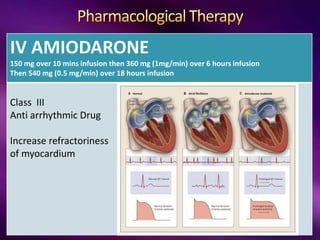 IV AMIODARONE
150 mg over 10 mins infusion then 360 mg (1mg/min) over 6 hours infusion
Then 540 mg (0.5 mg/min) over 18 hours infusion
Class III
Anti arrhythmic Drug
Increase refractoriness
of myocardium
 