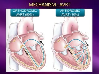 ORTHODROMIC
AVRT (90%)
ANTIDROMIC
AVRT (10%)
 