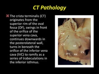 CT Pathology
The crista terminalis (CT) 
originates from the 
superior rim of the oval 
fossa (OF), swings in front 
of the orifice of the 
                                PM
superior vena cava, 
continues downwards in 
the posterolateral wall,        CT
                                           OF
turns in beneath the 
orifice of the inferior vena                    CS
cava (IVC) to ramify as a            IVC   ER
series of trabeculations in 
the inferior isthmus. 
 