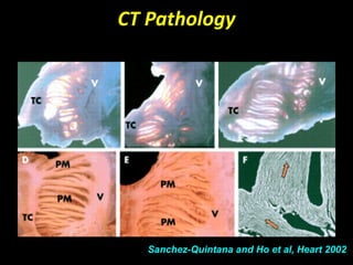 CT Pathology




   Sanchez-Quintana and Ho et al, Heart 2002
 