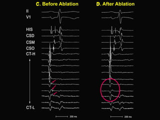 C. Before Ablation   D. After Ablation
 