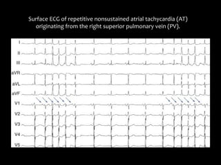 Surface ECG of repetitive nonsustained atrial tachycardia (AT) 
  originating from the right superior pulmonary vein (PV). 
 