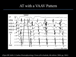 AT with a VAAV Pattern




(Zipes DP, Jalife J. Cardiac Electrophysiology: From cell to bedside, 4th edition. 2004; pg. 1061)
 