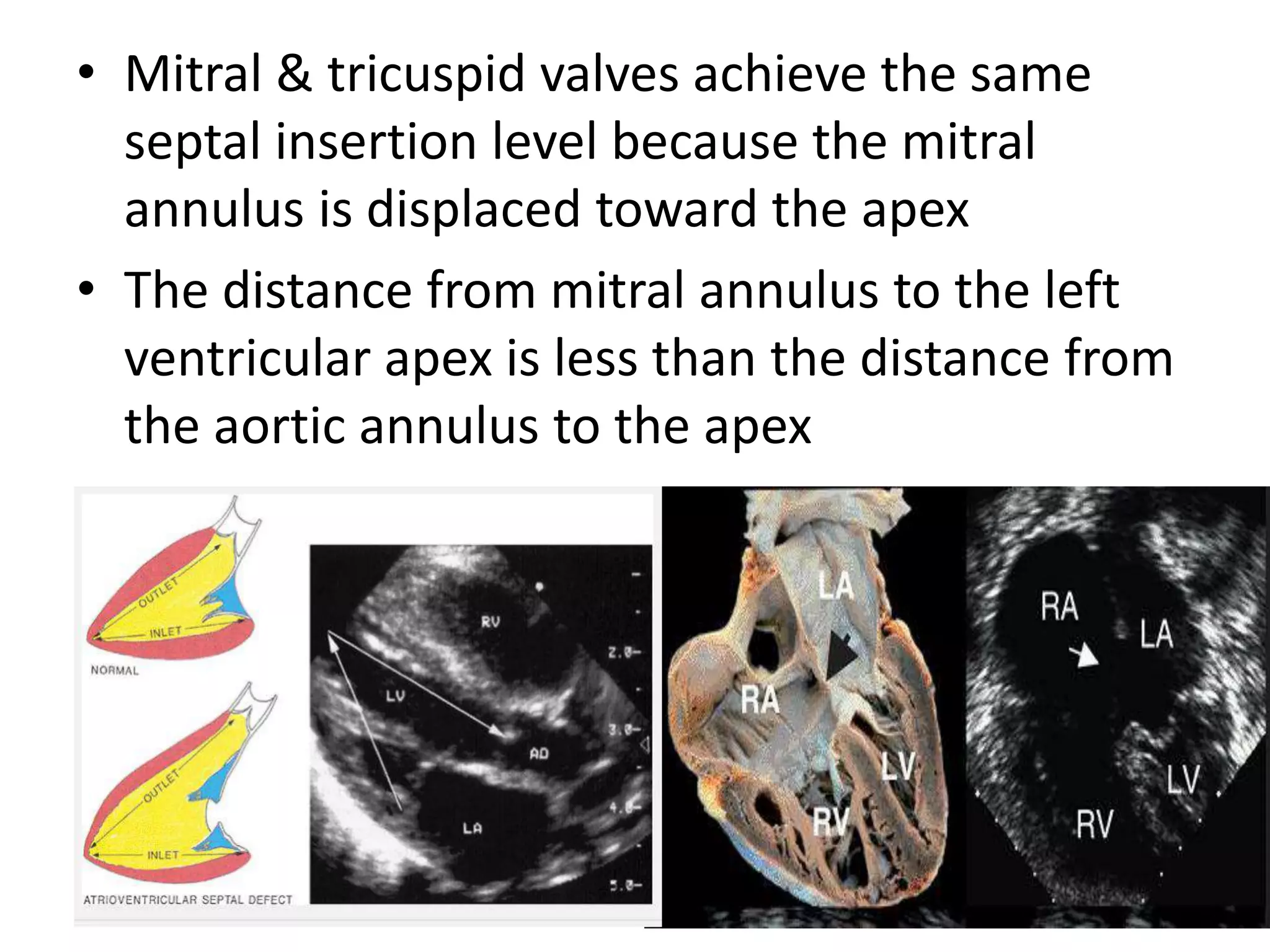 • Mitral & tricuspid valves achieve the same
septal insertion level because the mitral
annulus is displaced toward the apex
• The distance from mitral annulus to the left
ventricular apex is less than the distance from
the aortic annulus to the apex
 