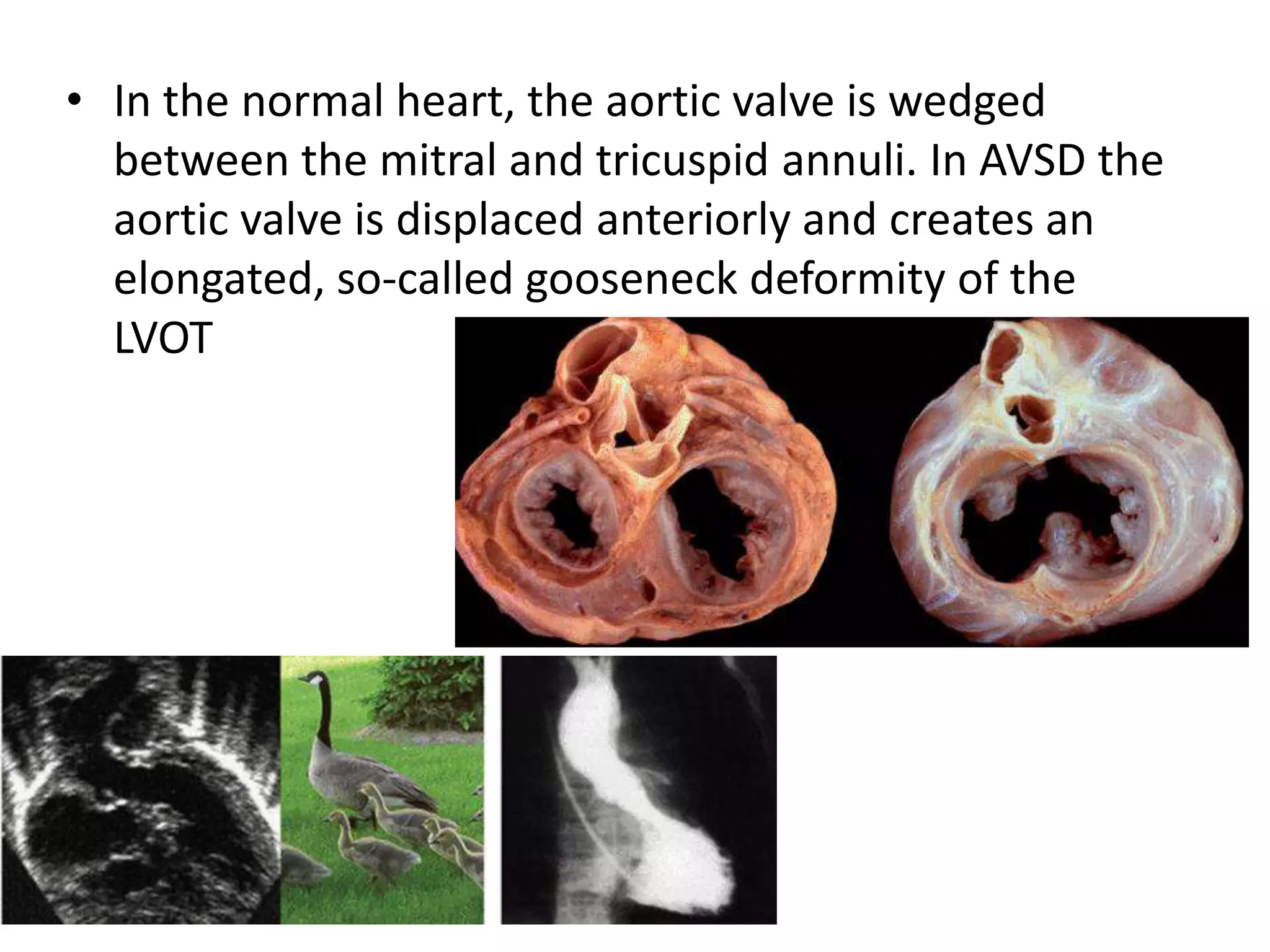 • In the normal heart, the aortic valve is wedged
between the mitral and tricuspid annuli. In AVSD the
aortic valve is displaced anteriorly and creates an
elongated, so-called gooseneck deformity of the
LVOT
 