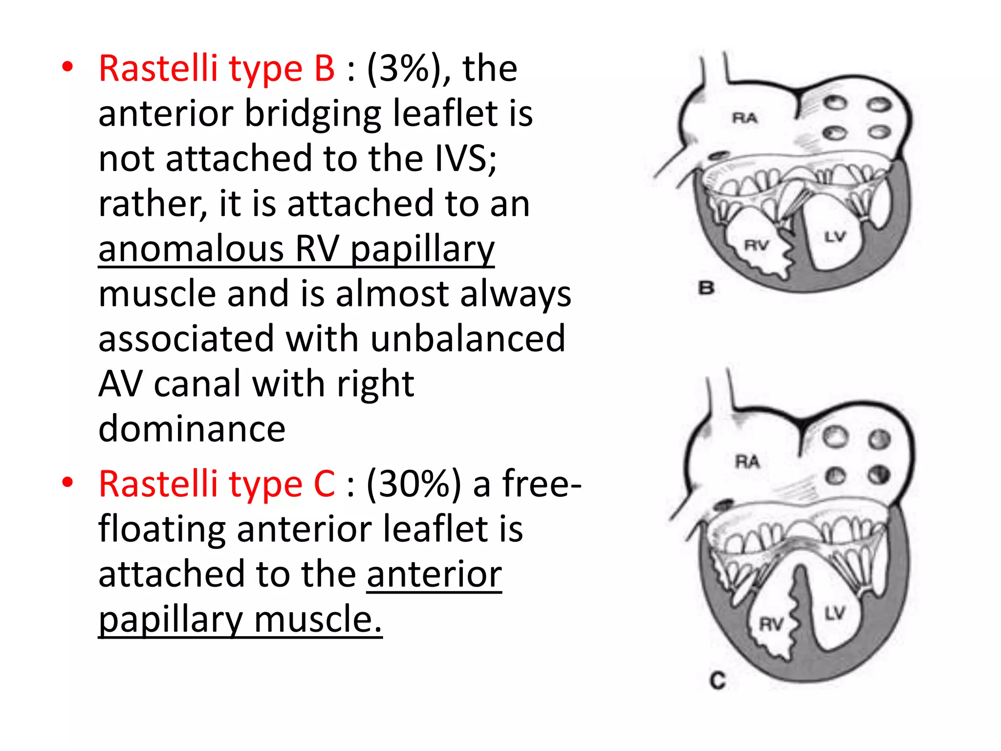 • Rastelli type B : (3%), the
anterior bridging leaflet is
not attached to the IVS;
rather, it is attached to an
anomalous RV papillary
muscle and is almost always
associated with unbalanced
AV canal with right
dominance
• Rastelli type C : (30%) a free-
floating anterior leaflet is
attached to the anterior
papillary muscle.
 